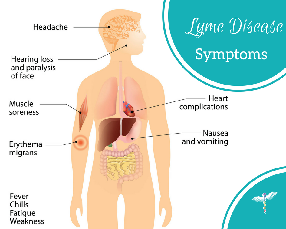 Lyme disease symptoms.